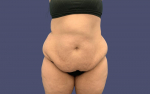 Abdominoplasty (Tummy Tuck) 2 Before